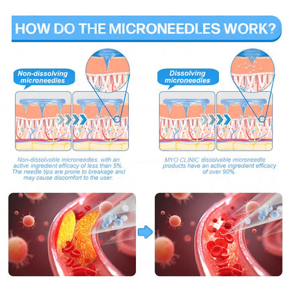 FDA Official Store | Myo Clinic GLP-1 Slim & Firm Nano Microneedle Patch with Collagen, Turmeric & Matrixyl 3000丨Obesity, Cardiovascular Disease, Diabetes, Sleep Apnea, Joint Problems and More